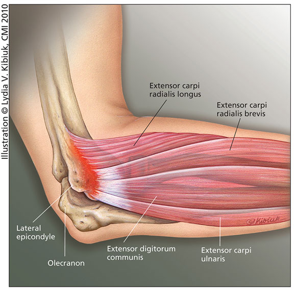 Tennis Elbow Without Tennis: Modern Treatment